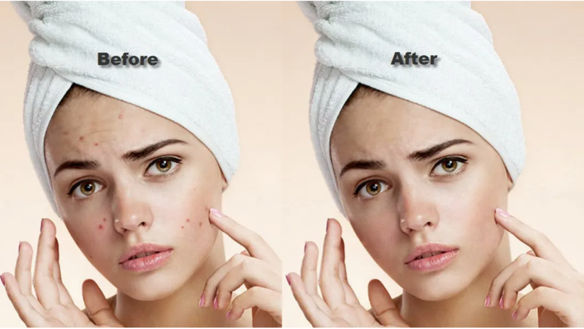 A better Healthy Acne Solutions for your skin